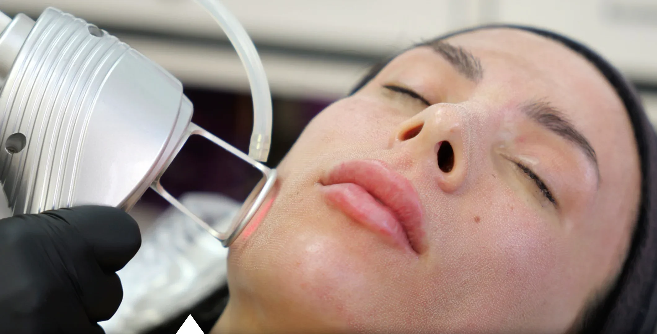 Laser CO2 Punto | Dermatologista em Brasília LiLian Mendes Dermatologista - Laser CO2 PUNTO